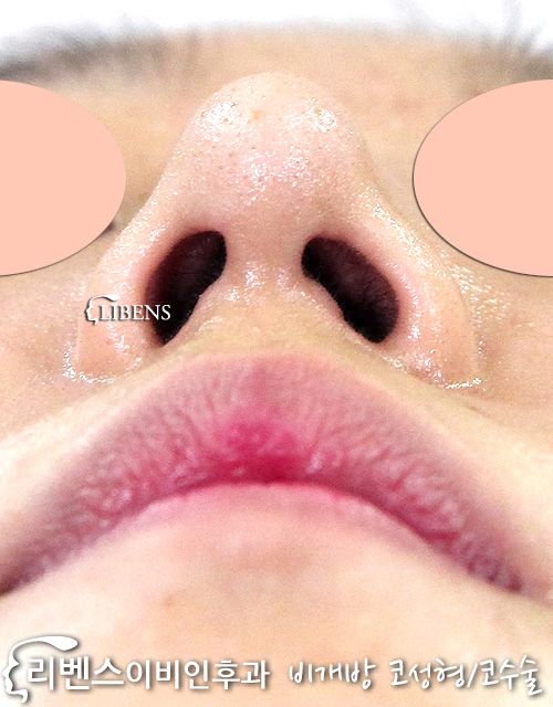 눌린 콧구멍 매부리코 메부리코 성형 수술 교정 코끝 연골재배치 성형 s555